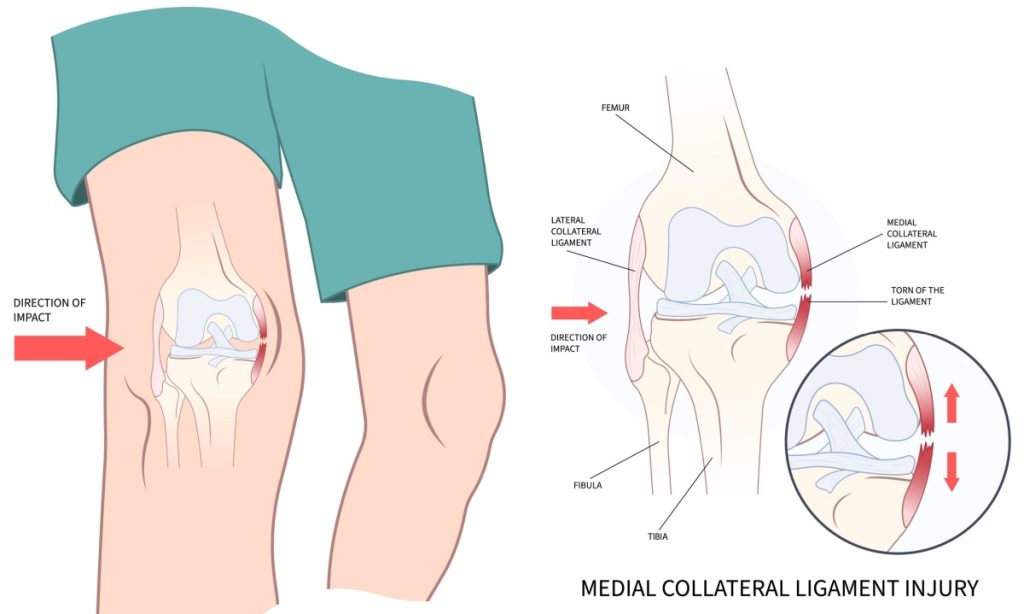 How To Prevent Soccer Knee Injuries With Knee Exercises
