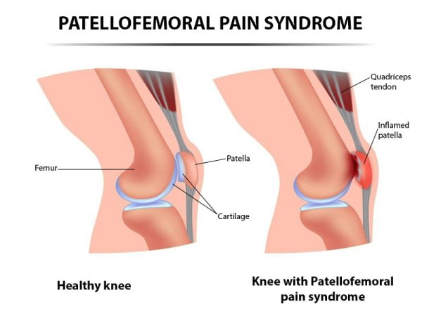 How To Prevent Soccer Knee Injuries With Knee Exercises